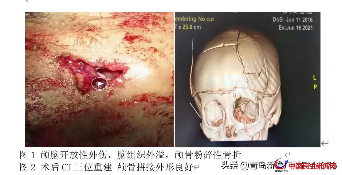 5歲男童6樓墜落命懸一線，婦兒醫(yī)院多學(xué)科協(xié)作再勝“死神”